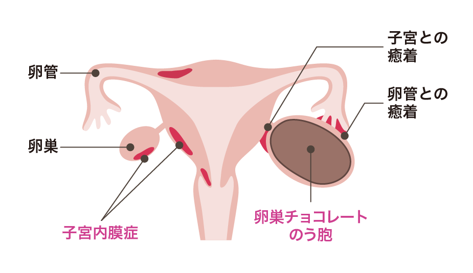 子宮内膜症